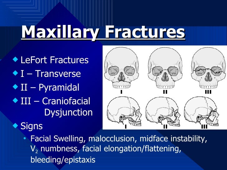 facial fracture slideshows Facial fracture slideshows